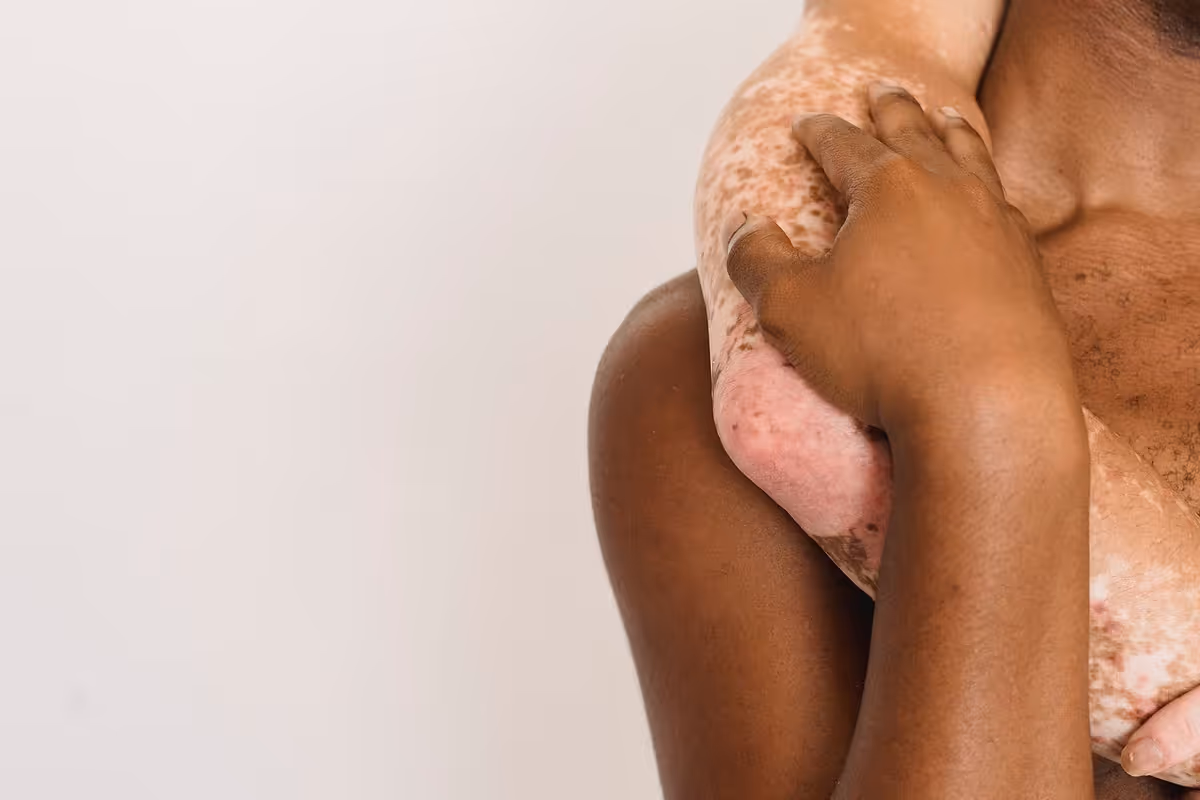 Ensayo BE BOLD: bimekizumab supera a risankizumab en artritis psoriásica