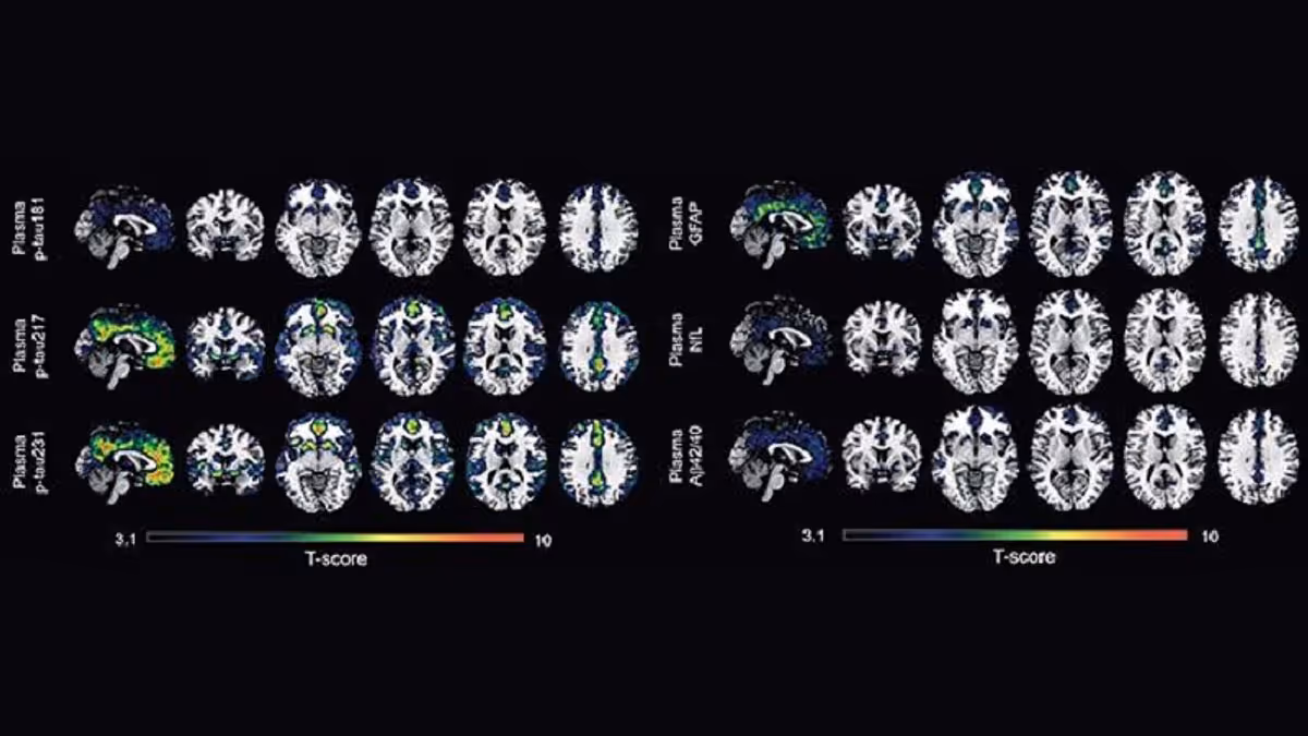 Alzhéimer: Nuevas terapias frenan el deterioro cognitivo